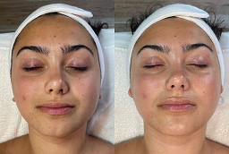 Laser Carbon Peel Before and After