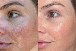 Melasma Treatment Before and After