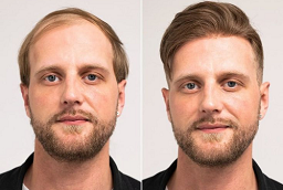 Natural Hairline Treatment Before and After