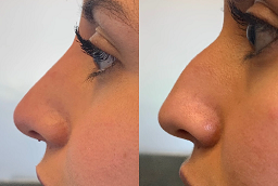 Non Surgical Nose Job 8 Non Surgical Nose Job After and Before