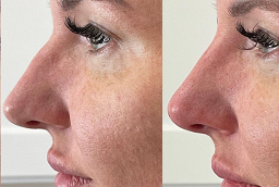 Non Surgical Nose Job Before and After