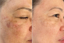 Pigmentation Treatment After and Before