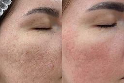 Pigmentation Treatment Before and After