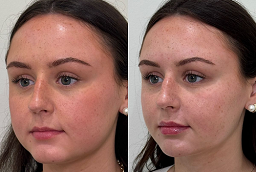 Radiofrequency Treatments After and Before