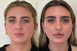 Skin Toning Treatment After and Before