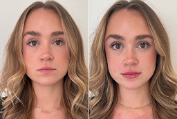 Skin Toning Treatment 8 Skin Toning Treatment Before and After