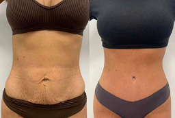 Slimming Treatments 8 Slimming Treatments After and Before