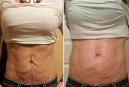 Slimming Treatments Before and After