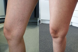 Spider Veins Treatment After and Before