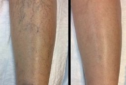 Spider Veins Treatment Before and After