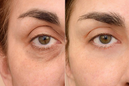 Before and After Dark Circles Treatment