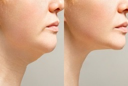 Before and After Double Chin Liposuction