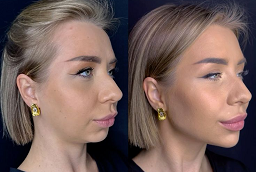 Before and After Kybella Treatment