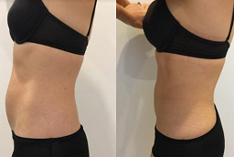 Before and After Laser Liposuction