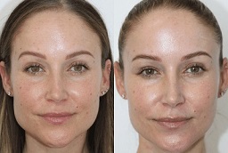 Before and After Sculptra Fillers