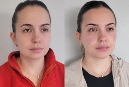 Before and After Volite Fillers