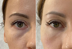 Dark Circles Treatment After and Before