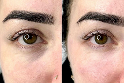 Dark Circles Treatment Before and After