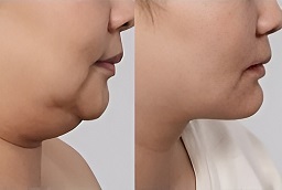 Double Chin Liposuction Before and After