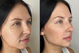 Kybella Treatment After and Before