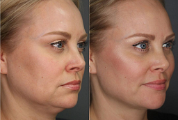 Kybella Treatment Before and After