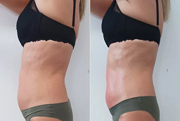Laser Liposuction After and Before