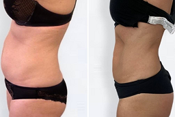 Laser Liposuction Before and After