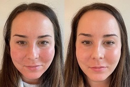 Sculptra Fillers After and Before