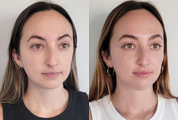 Volite Fillers After and Before