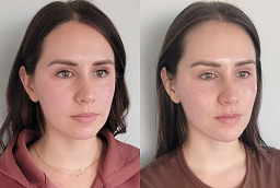 Volite Fillers Before and After