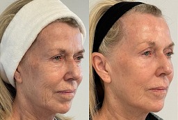 Wrinkle Smoothing After and Before
