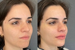 Wrinkle Smoothing 8 Wrinkle Smoothing Before and After