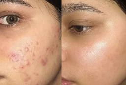 Acne Treatment After and Before