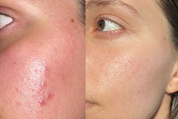 Acne Treatment Before and After