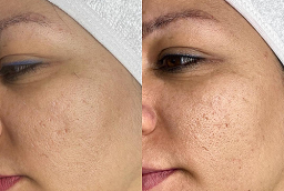 Before and After Skincare Treatment