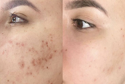 Before and After Acne Treatment