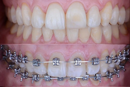 Before and After Dental Braces
