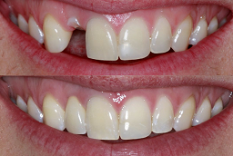 Before and After Dental Implants