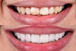 Before and After E-Max Veneers