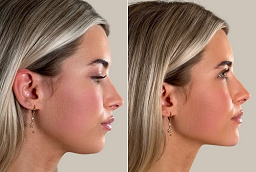 Before and After Jawline Filler Injections