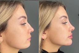 Before and After Liquid Rhinoplasty