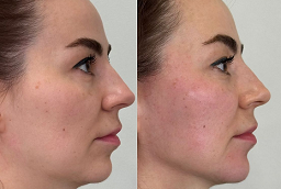 Chin Reduction Before and After