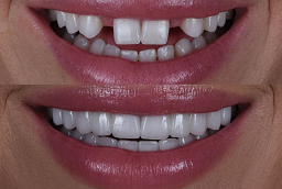 Dental Implants After and Before