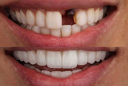 Dental Implants 8 Dental Implants Before and After