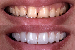 E-Max Veneers After and Before