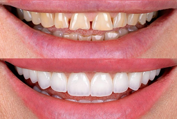 E-Max Veneers Before and After