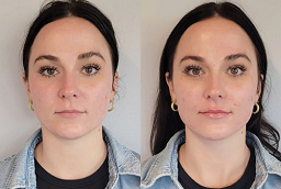 Facelift Surgery After and Before