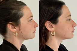 Jawline Filler Injections After and Before