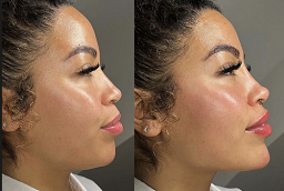Jawline Filler Injections Before and After