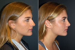 Liquid Rhinoplasty After and Before